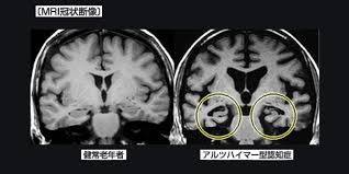 図1_アルツハイマー型認知症.jpg